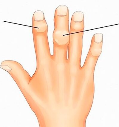 Heberdeni ja Bouchardi sõlmed interfalangeaalsetel liigestel koos artroosiga