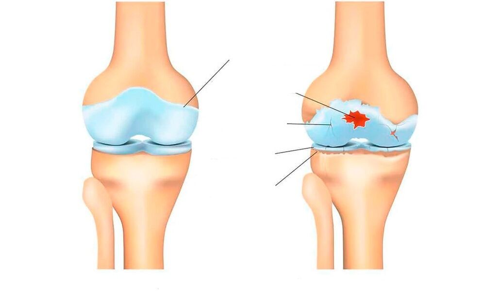 terve liiges ja artroosiga