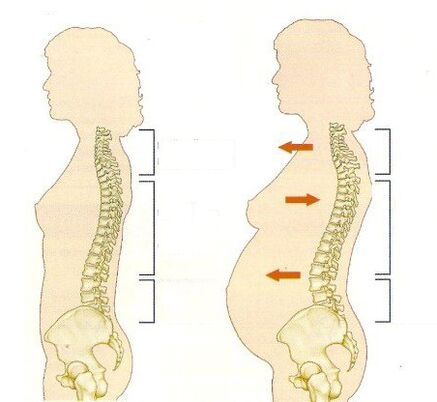 osteokondroos raseduse ajal