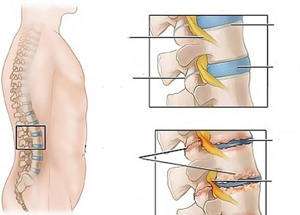 osteokondroosist tingitud muutused ketastes